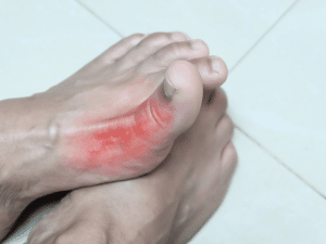 Gout Relief1
