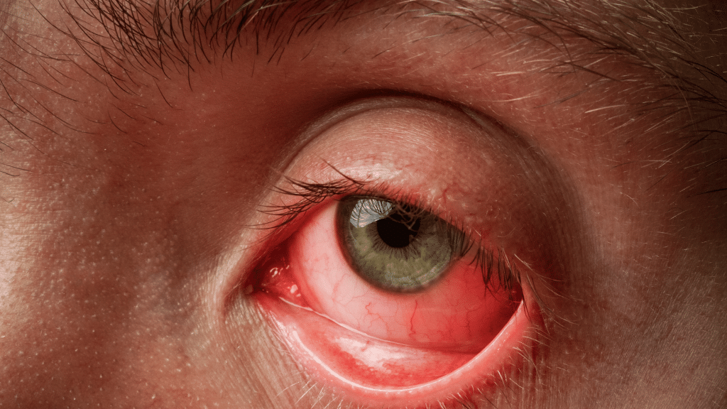 Best Practices to Overcome Conjunctivitis with Ease
